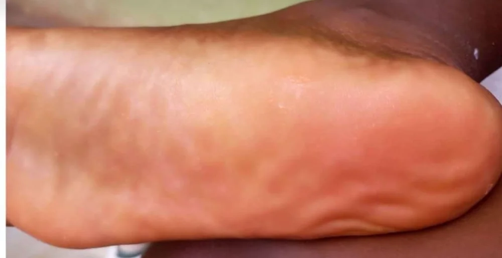 Client's heel after treatment, soft and smooth